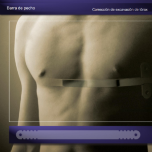 BARRA DE PECTUS EXCAVATUM